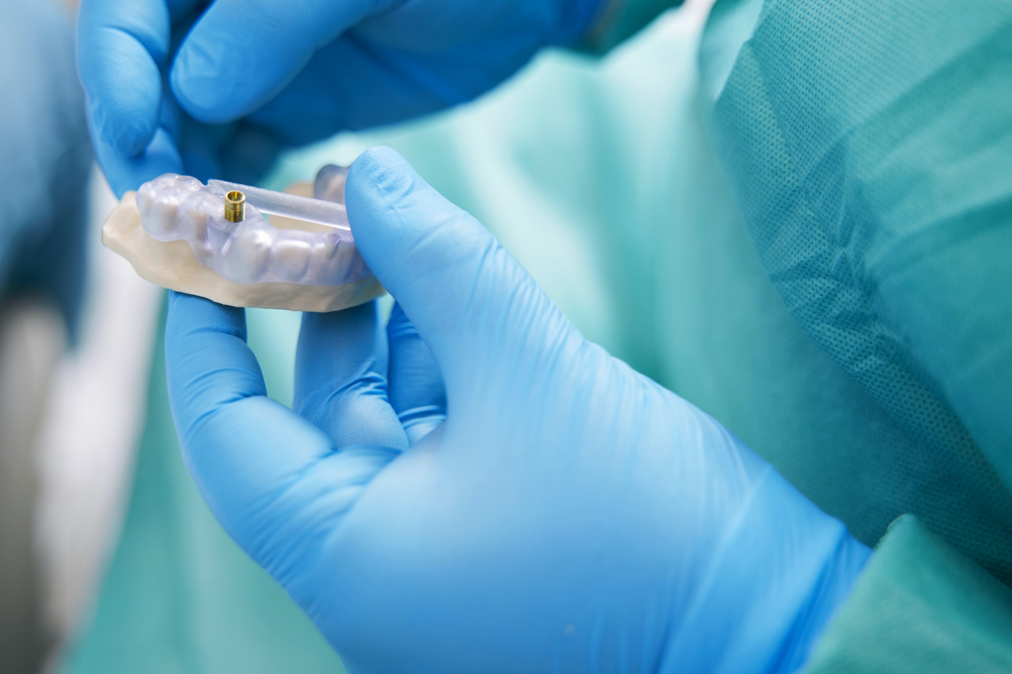 Dentist hands holding teeth model with dental implant – NAYA